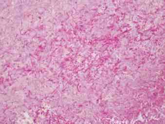 PAS stain of valvular tissue (x400 magnification) demonstrating... | Download Scientific Diagram