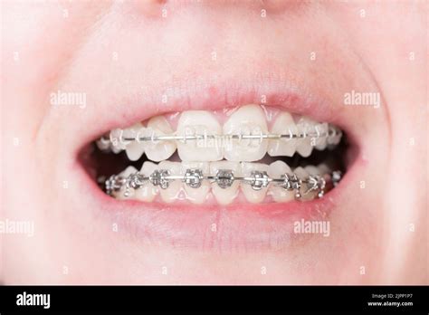 Metal brace hi-res stock photography and images - Alamy