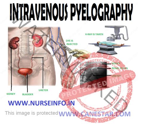 INTRAVENOUS PYELOGRAPHY - Nurse Info