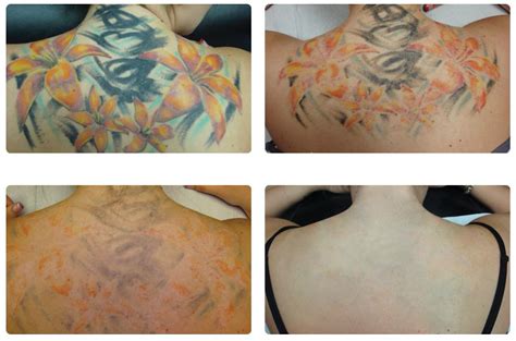 Common Misconceptions about Laser Tattoo Removal - Dr Nathan Holt