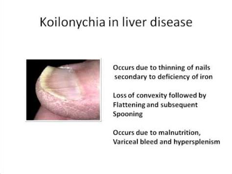 Koilonychia and Dupuytren's contracture in liver disease - YouTube