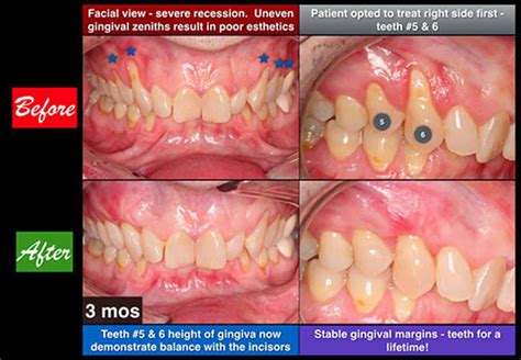 Gum Graft | Bayside Periodontics & Dental Implants