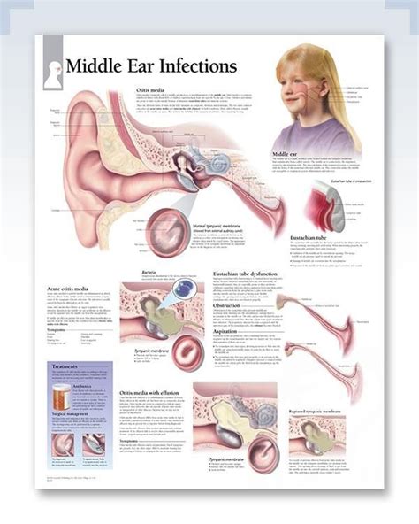 Middle Ear Infections Chart 22x28 | Middle ear, Ear infection, Swimmers ...