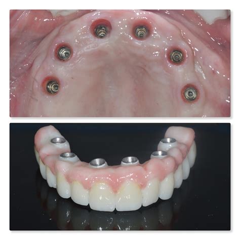 full arch dental implants zirconia milled - Infinity Dental Clinic