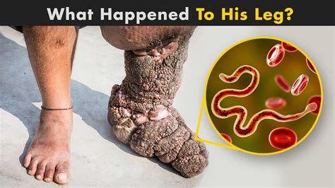 Elephantiasis - What Happen To Our body In Elephantiasis? (Urdu/Hindi) - YouTube