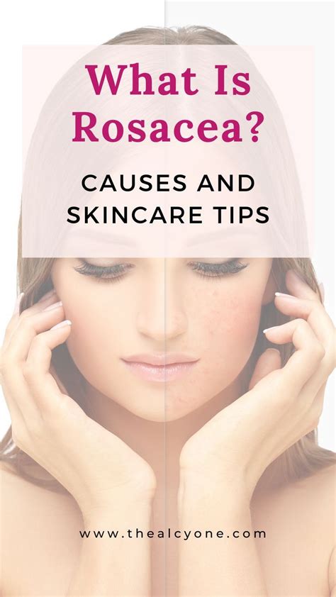 Rosacea causes and skincare tips – Artofit