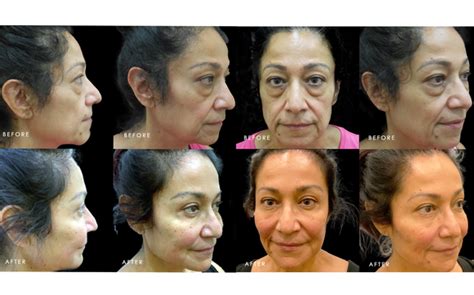 Voluma & Sculptra Results #001 · Gemini Plastic Surgery Rancho Cucamonga, Chino Hills, Inland ...