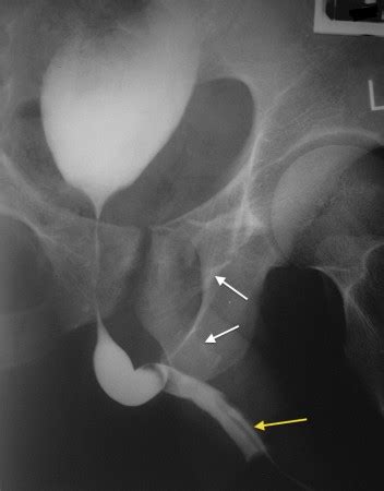 Tablas De Isr 2023 Dofusbook Retrograde Urethrogram - IMAGESEE