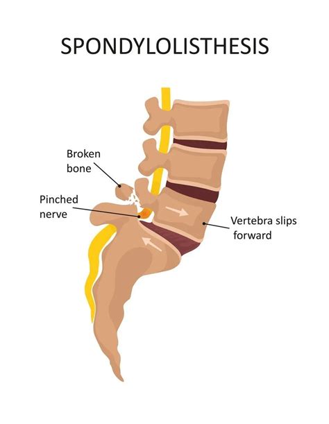 Inversion Table Benefits: Lower Back Pain, Sciatica, Herniated Disk