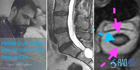 ANKYLOSING SPONDYLITIS SACROILIITIS CT CHANGES SACRO ILIAC JOINT SPINE ...