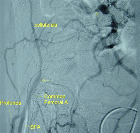 External iliac artery occlusion seen on a digital subtraction angiogram ...