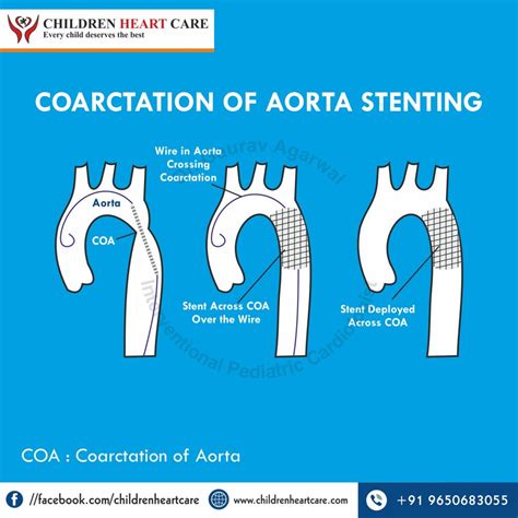 Coarctation of Aorta Treatment in Delhi - Dr. Gaurav Agrawal