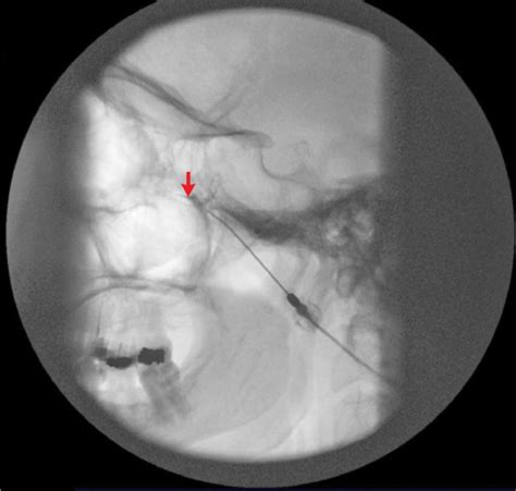 Sphenopalatine Ganglion Block | Anesthesia Key