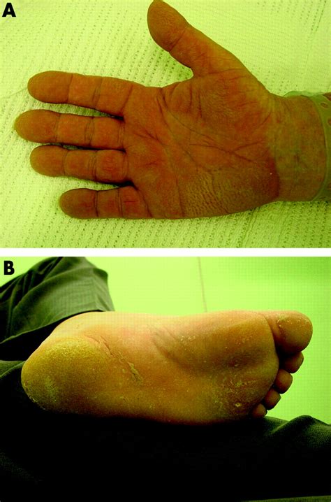 Palmoplantar keratoderma (“tripe palms”) associated with primary pulmonary adenocarcinoma | Thorax