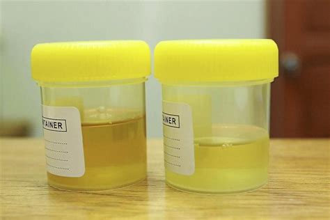 Is It Normal to Have Urine in Bright Yellow Color? | New Health Advisor