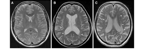 Mild Microvascular Ischemic Disease - Captions Quotes