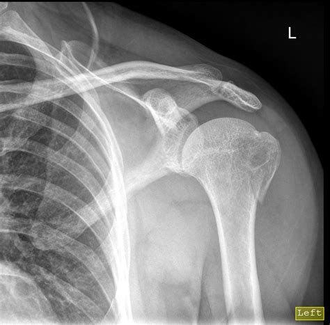 Humeral Greater Tuberosity Fracture