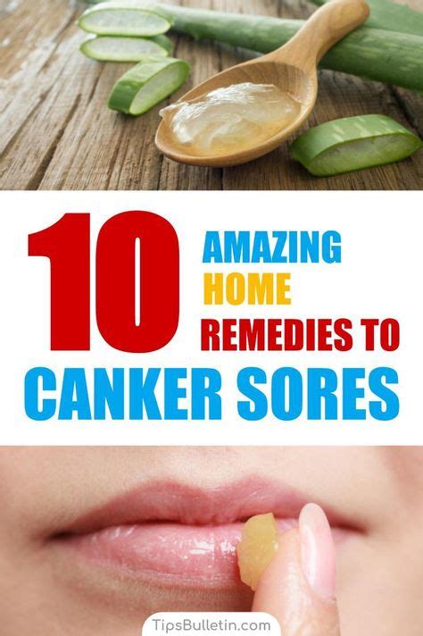 10 Amazing Homemade Solutions for Canker Sores in 2020 | Canker sore, Canker sore remedy, Cankers