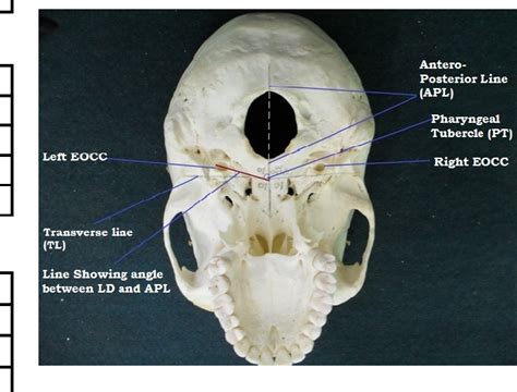 Carotid Canal