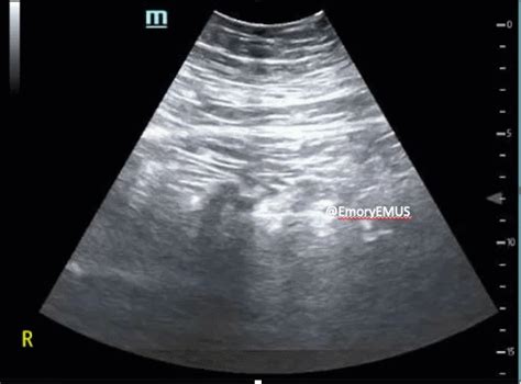 Small Bowel Obstruction 4 | Emory School of Medicine