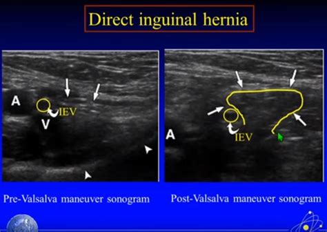 Direct And Indirect Inguinal Hernia