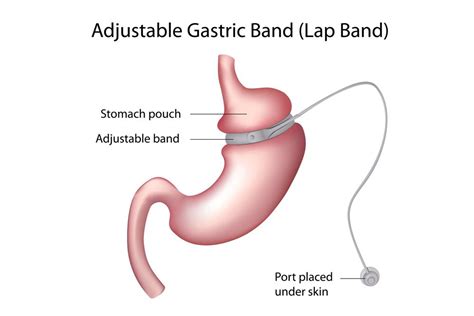 Gastric Bypass vs LAP-BAND - Plano, TX