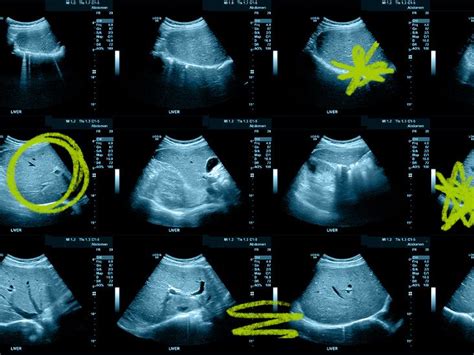 Abnormal results for liver ultrasound: what can they mean?