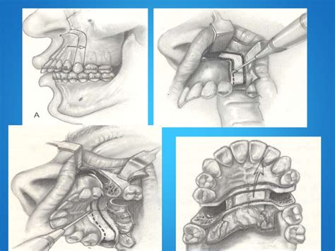 Lefort 1 osteotomy