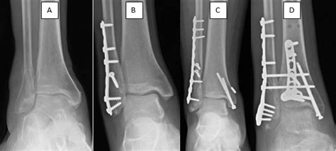 Ankle Fracture | Orthopaedic Trauma Association (OTA)