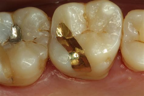 Updates in Dental Excellence: Gold Inlay Examples on My Happy Patients