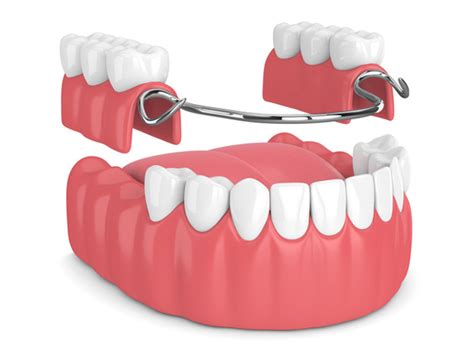 Removable Partial Denture | DrJCares Removable Partial Dentures