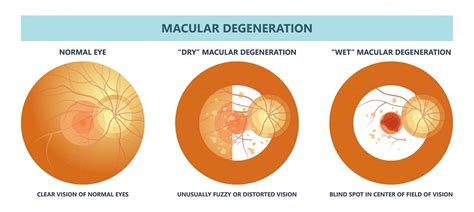 Wet vs. Dry Macular Degeneration: What’s the Difference? | Discover Vision