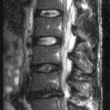 T2 weighted sagittal MRI scan of the lumbar spine. | Download Scientific Diagram