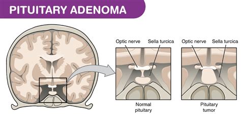 Pituitary Adenoma - Symptoms, Treatments and its Causes