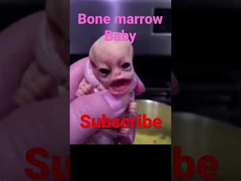 Bone marrow Baby. 😢 sad - YouTube