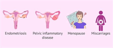 Causes of retroverted uterus