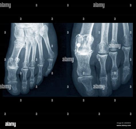 Osteoarthritis of the foot. X-rays of the left foot of a 75-year-old ...