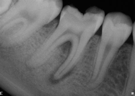 Quia - Endo X-rays