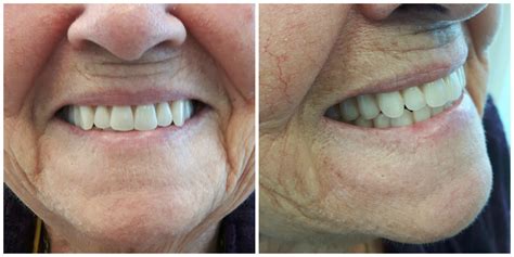 Complete Upper & Lower Dentures | Kelowna Denture Clinic