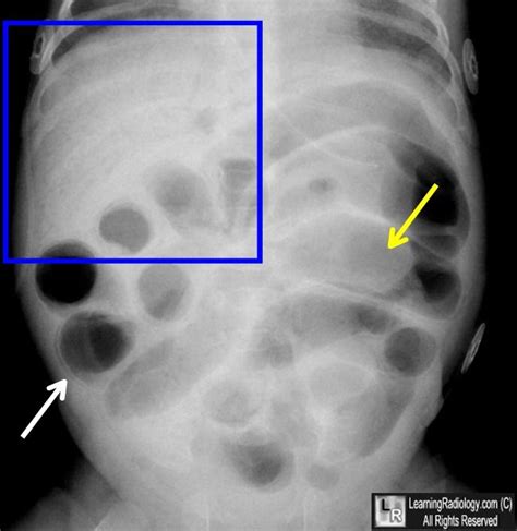 Welcome to LearningRadiology - necrotizing, enterocolitis, nec, newborn, premature, preemie ...