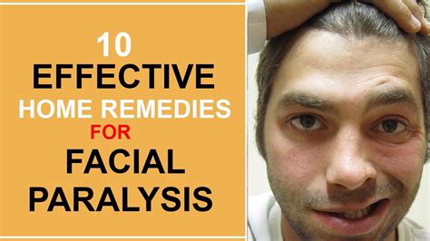 10 Effective Home Remedies For Facial Paralysis - YouTube