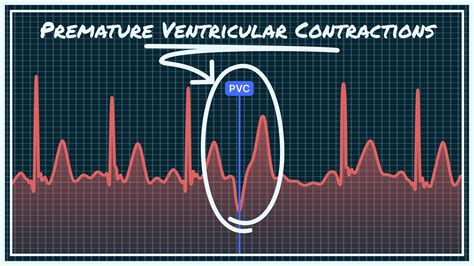 Premature Ventricular Contractions Pvcs Animation Premature Heart ...