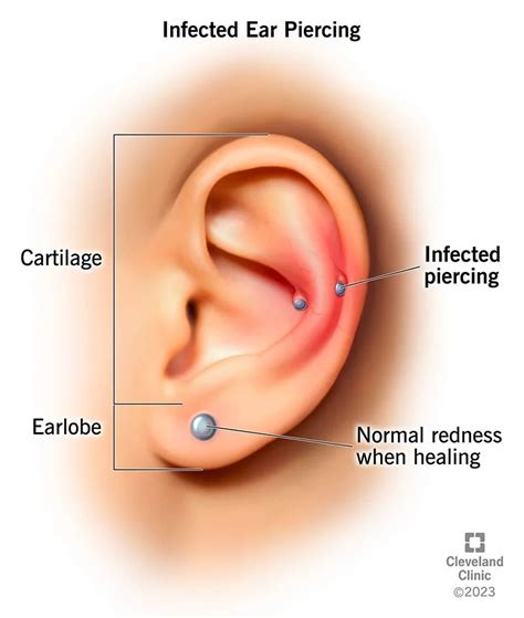 How to Treat an Infected Ear Piercing? – Helios Global