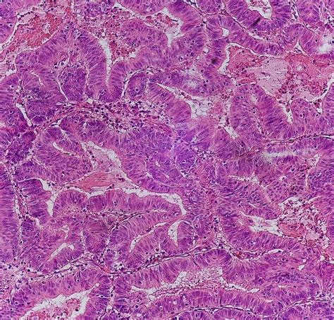 Histopathology of Colorectal Carcinoma | Encyclopedia MDPI