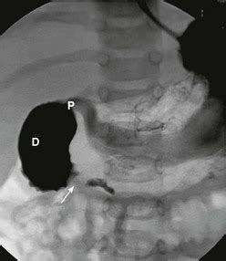 Duodenal and Intestinal Atresia and Stenosis | Obgyn Key