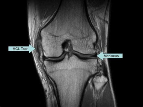 Sports Injury Bulletin - Diagnose & Treat - Medial collateral ligament ...