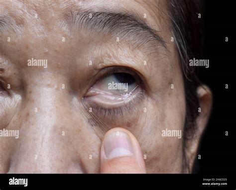 Deficiency anemia hi-res stock photography and images - Alamy