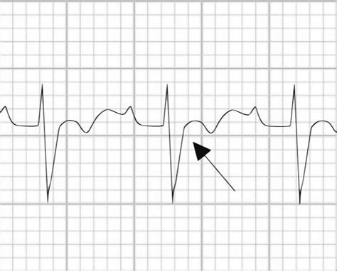 Arrhythmogenic Right Ventricular Dysplasia (ARVD) • ECG Library