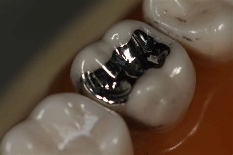 Class II Amalgam Restoration Polishing | Stevenson Dental Solutions