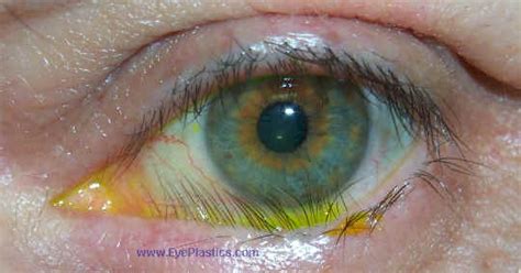 Trichiasis Boise | Distichiasis Idaho